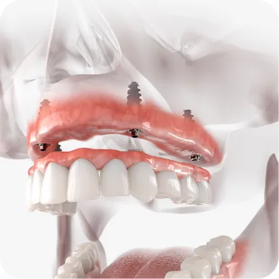 dentures being placed on implants
